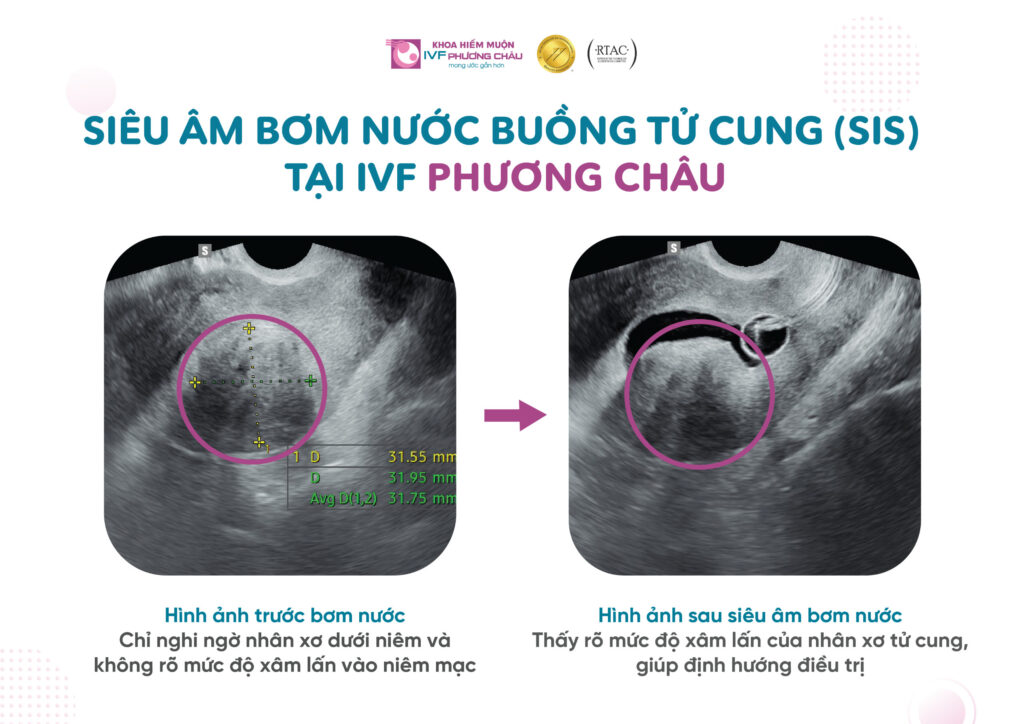 Siêm âm bơm nước buồng tử cung tại IVF Phương Châu (SIS)